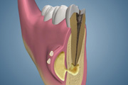 Swelling Treated with Incision